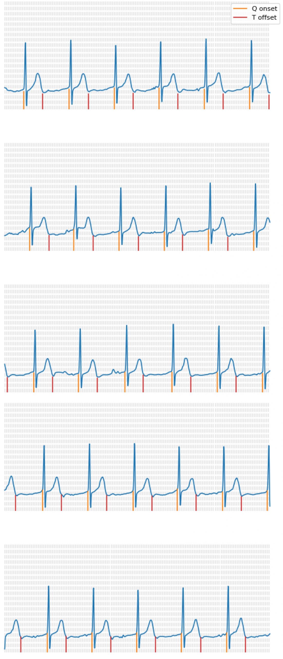 ECG Analysis Result Example - Cardiac Markers